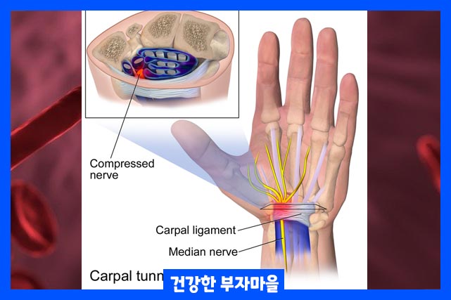 수근관 증후군