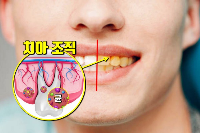 잇몸이 붓고 아플때 당뇨,잇몸병 치주염,풍치,건강,팁줌 매일꿀정보