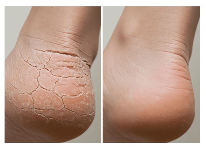 비판텐 연고 효능