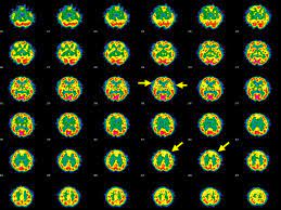 갑상선 기능 저하증