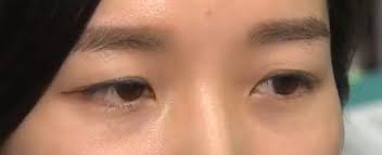 눈 붓기 빨리 빼는법