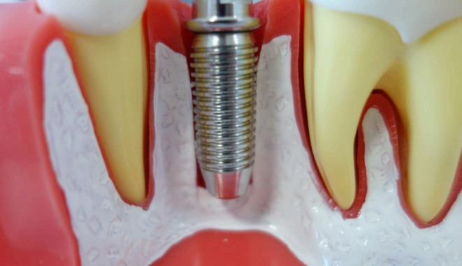 임플란트 픽스쳐 삽입 사진