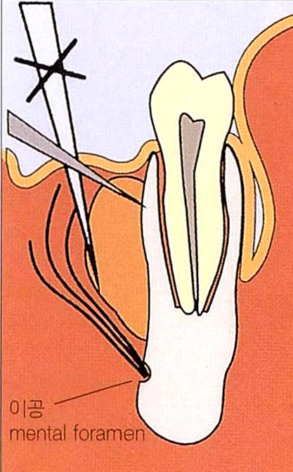 blade를 골면에 수직으로 위치시키는 모식도