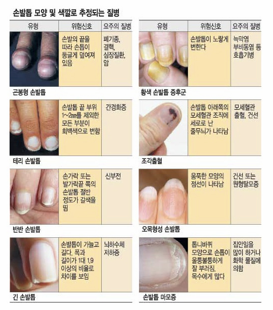 손발톱 모양 및 색깔로 추정되는 질별 이미지