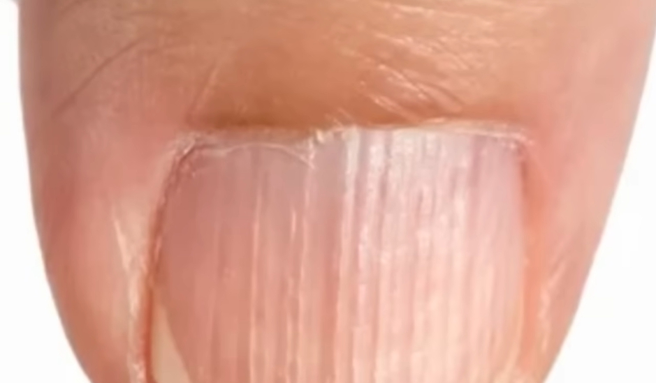 손톱에 세로줄이 생기는 이유