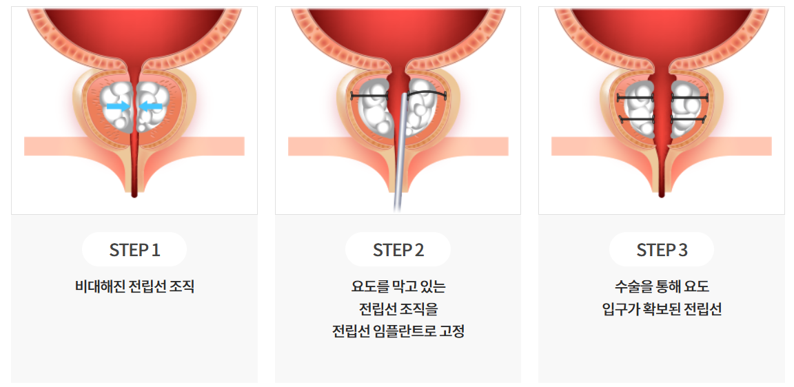 유로리프트