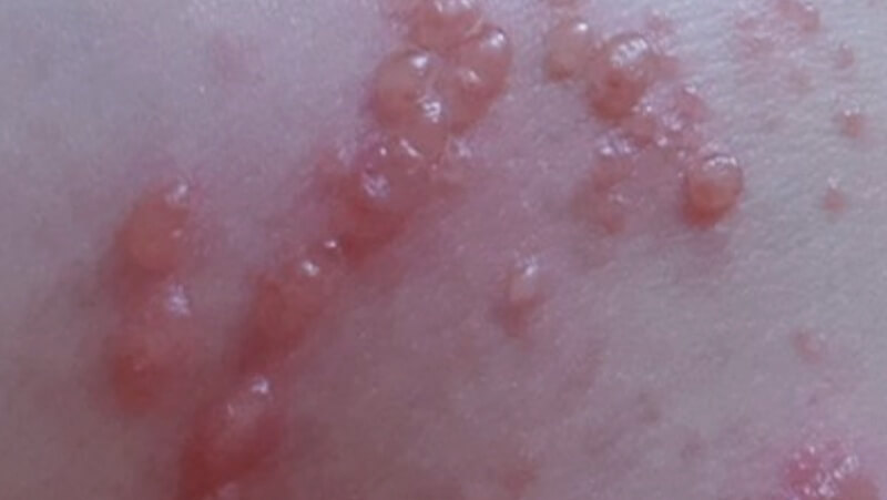 대상포진으로-발생된-수포