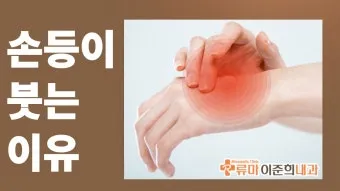 손등 붓는 이유 혈액순환 문제 증상과 해결법 정리_37