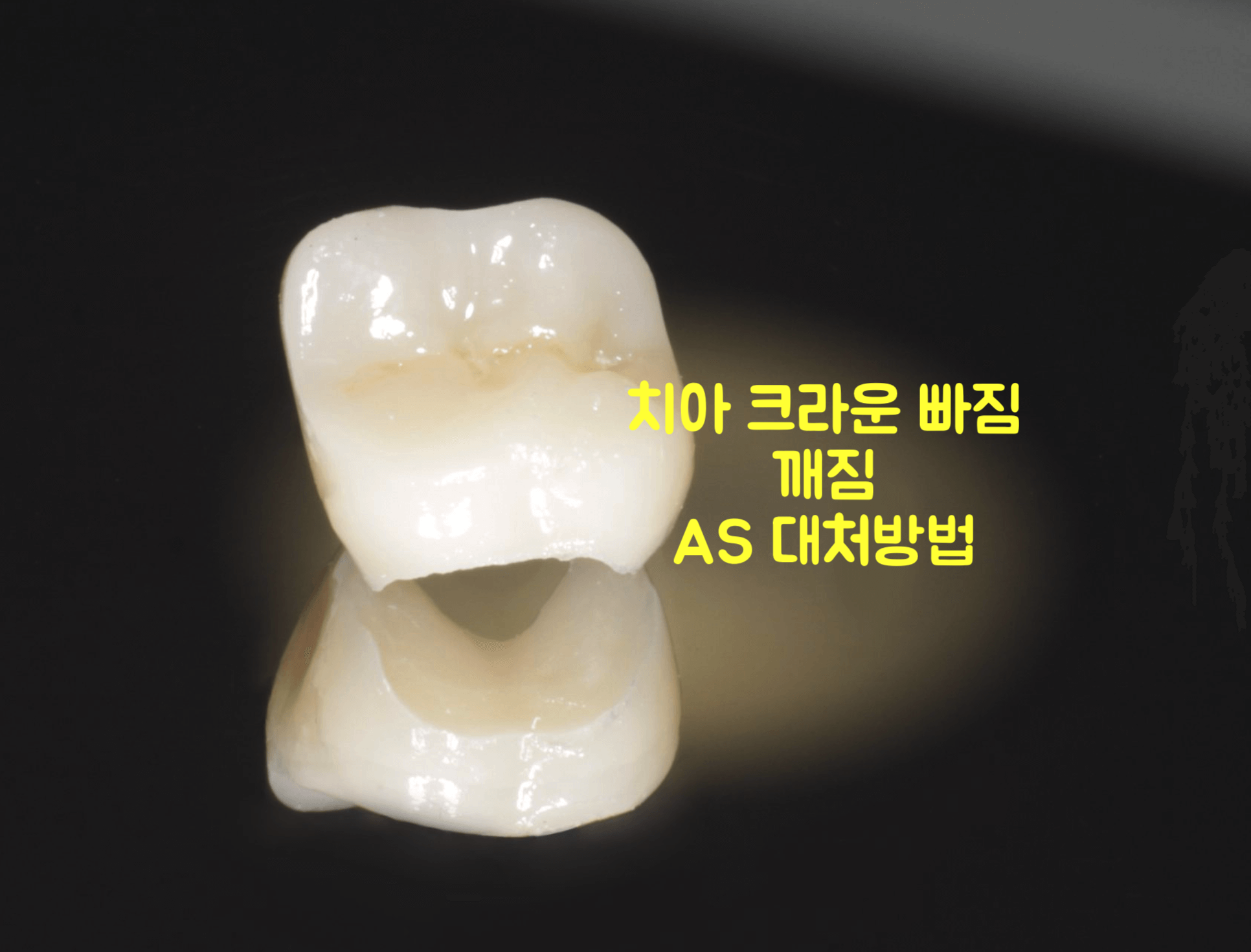 치아 크라운 빠짐