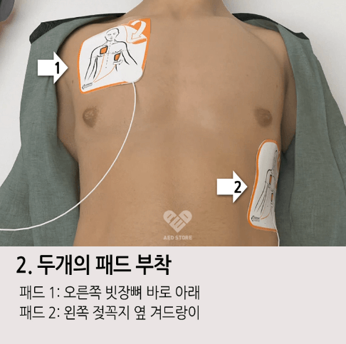 자동심장충격기 두 개의 패드 부착 위치 사진