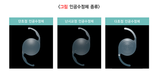 인공수정체의 종류