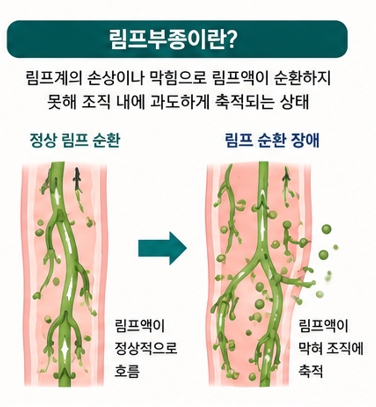 림프부종