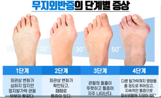 무지외반증, 여름철 신발이 발 건강에 미치는 영향 관련 이미지