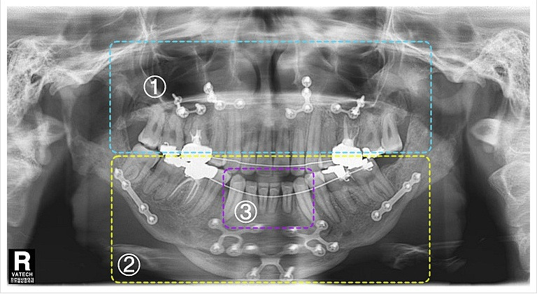 삼악수술의 전후 비교 2