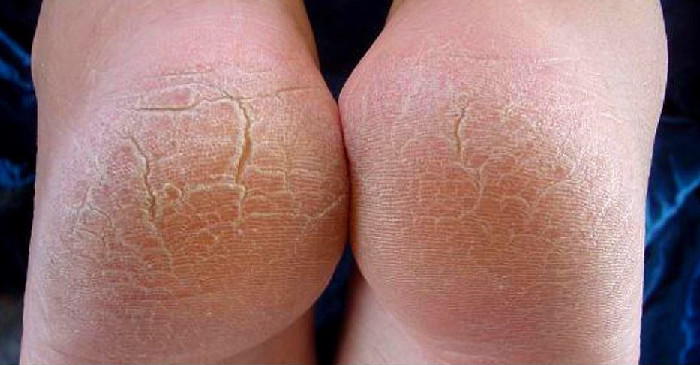 건조한 발 뒤꿈치 각질 제거 전후 관리