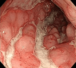 크론병 증상 원인 진단 치료 식단까지