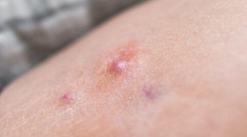 이홍기 화농성 한선염 증상 5가지 ❘ 치료방법 4가지 공유해요