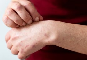 피부 붉은반점 13