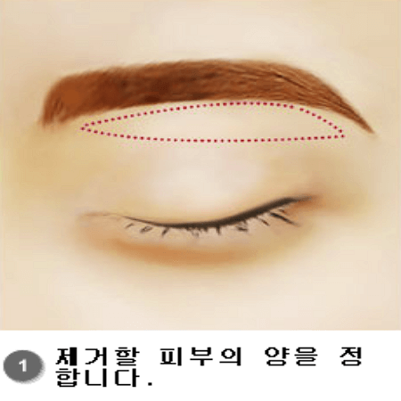 눈썹거상술 첫번째 단계