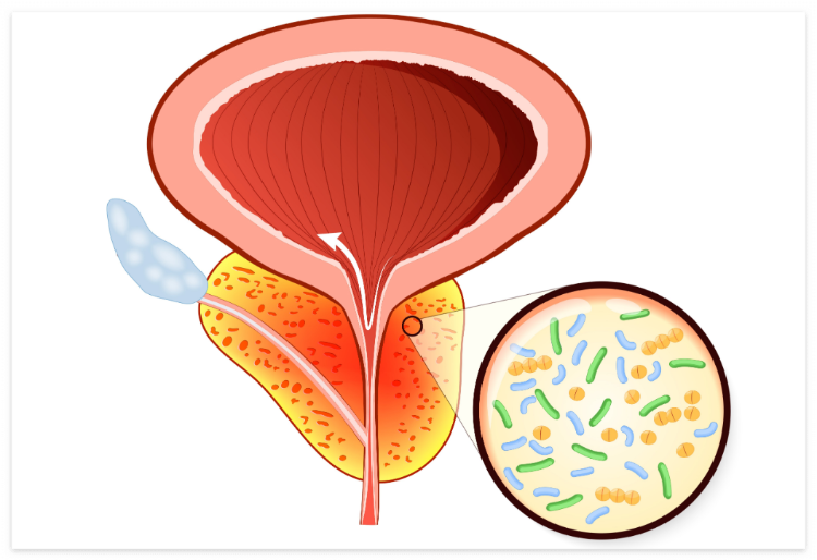 전립선염 원인과 검사방법