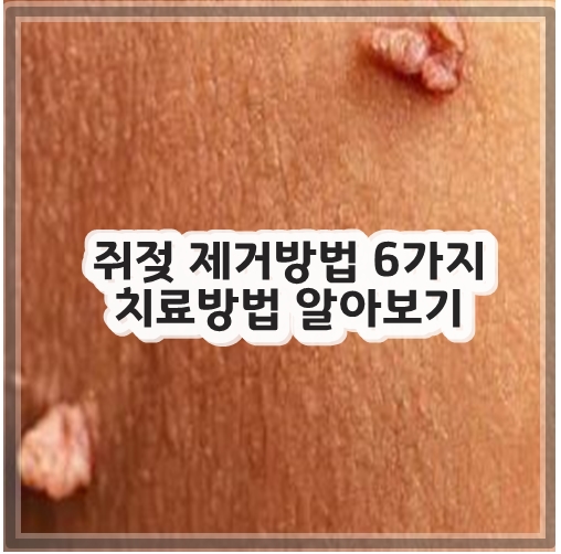 쥐젖 제거방법 6가지 치료방법 알아보기