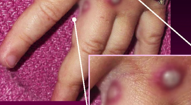 엠폭스의 피부 증상