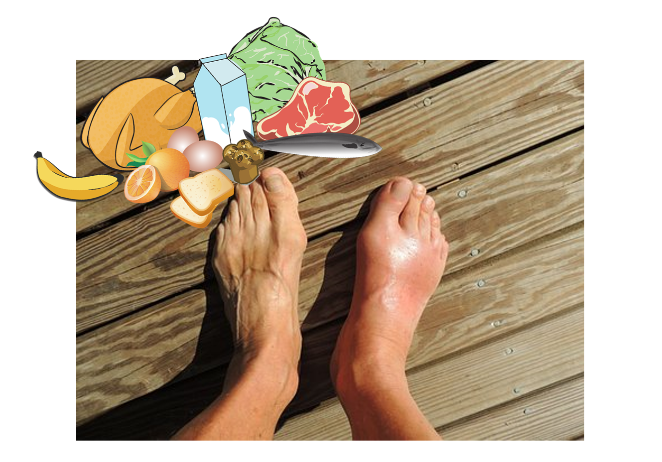 통풍에 안좋은음식, 요산수치낮추는법, 초기증상 그리고 치료