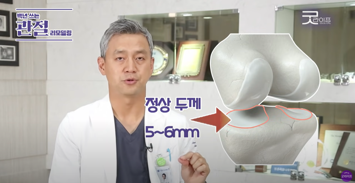 정상 연골 두께는 5 ~ 6mm