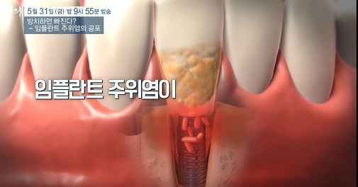임플란트주위염