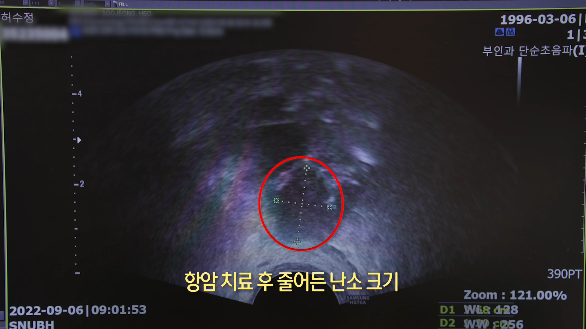 KBS 생로병사의 비밀 836회 난소 노화에 맞서다, 난자 냉동 방법 오늘방송 다시보기 정보