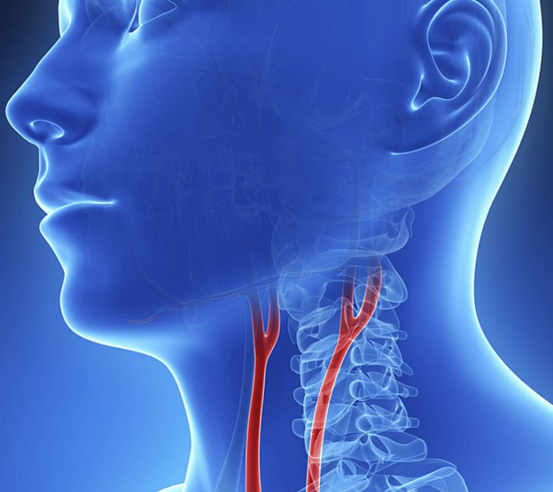 경동맥 관련 사진