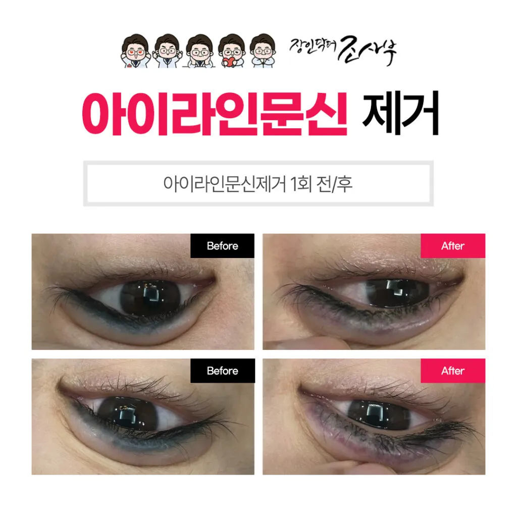 아이라인 제거