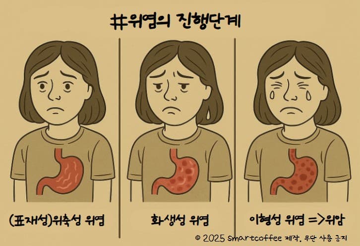 표재성 위염, 건강검진에서 매번 나온다면? 증상·위험·관리법 총정리