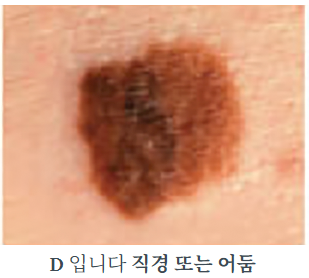 흑색종
