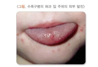 수족구 초기 증상 어른 감염 격리기간 예방 치료 완전 가이드_12