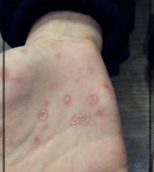 남자 매독 증상, 원인, 치료방법 총정리