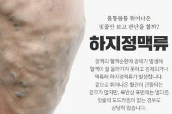 하지 정맥류 증상 치료방법과 예방 생활습관_16