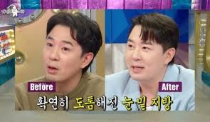 눈밑지방재배치