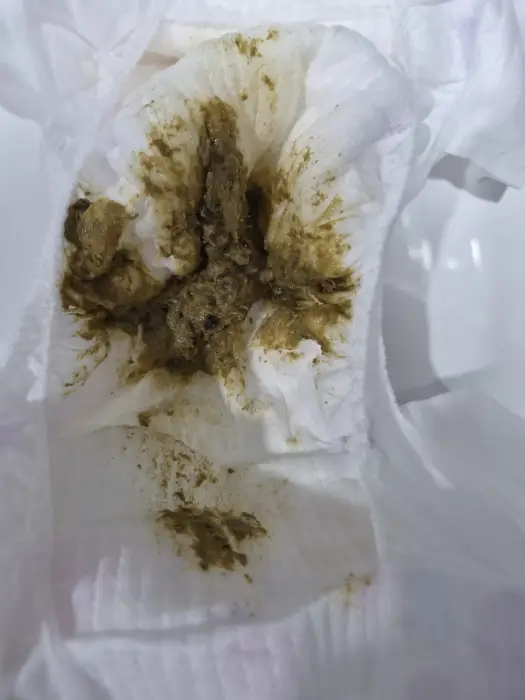 약먹고 점차 호전보이는 아이 변