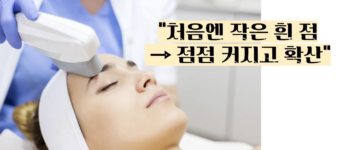 백반증 초기증상