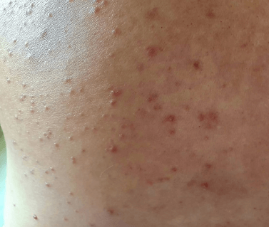 말라쎄지아(진균성 모낭염) 