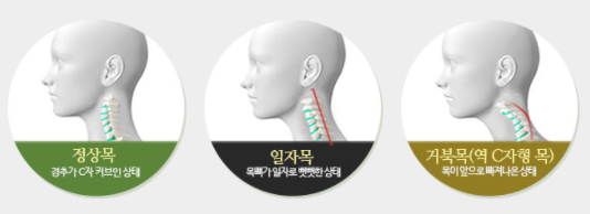 정상목 일자목 거북목 비교