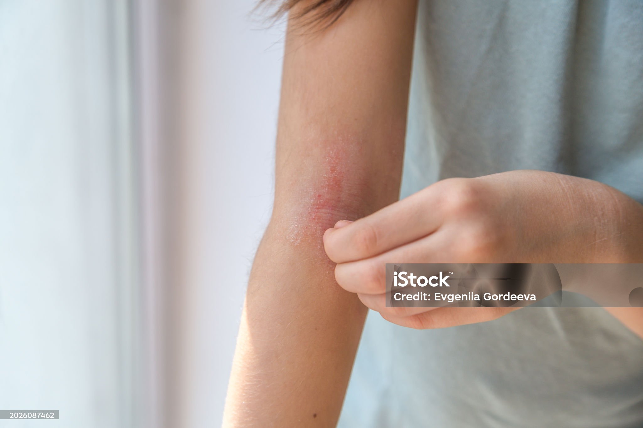 습진으로 인해 가려워서 긁는 모습