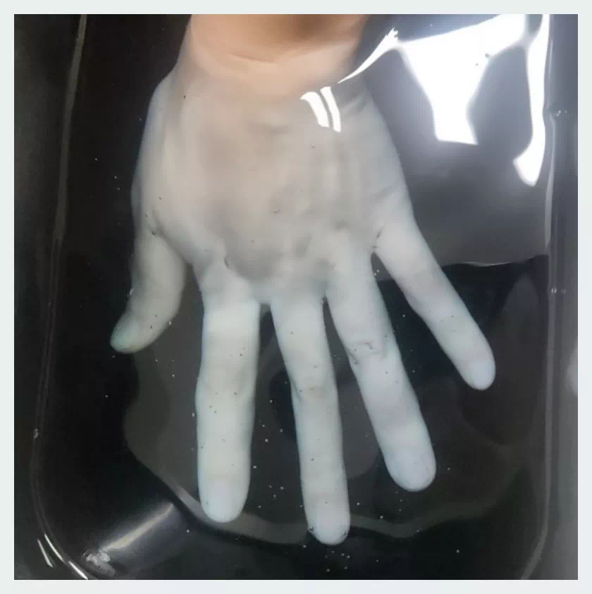 파라핀 통증 치료