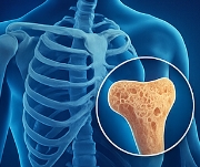 골다공증에 좋은 음식