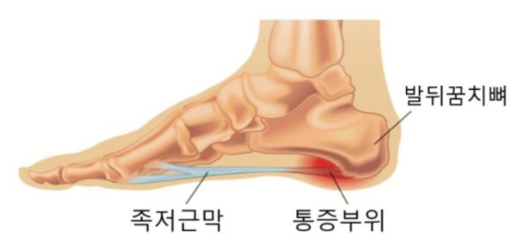 족저근막염