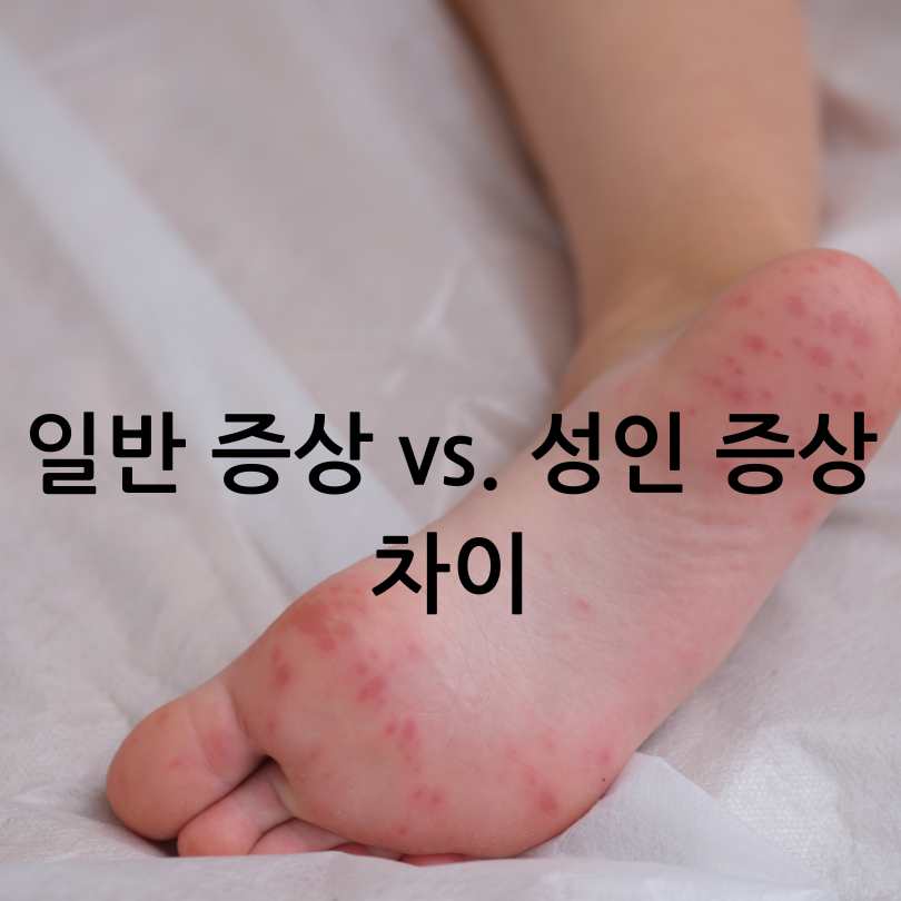 성인수족구 감염&amp;#44; 증상&amp;#44;원인&amp;#44; 경험담까지