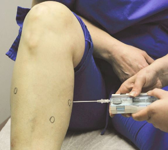 급성-구획증후군-치료