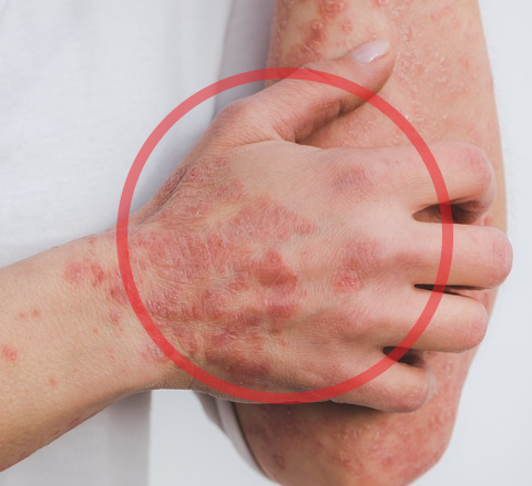 건선 피부염