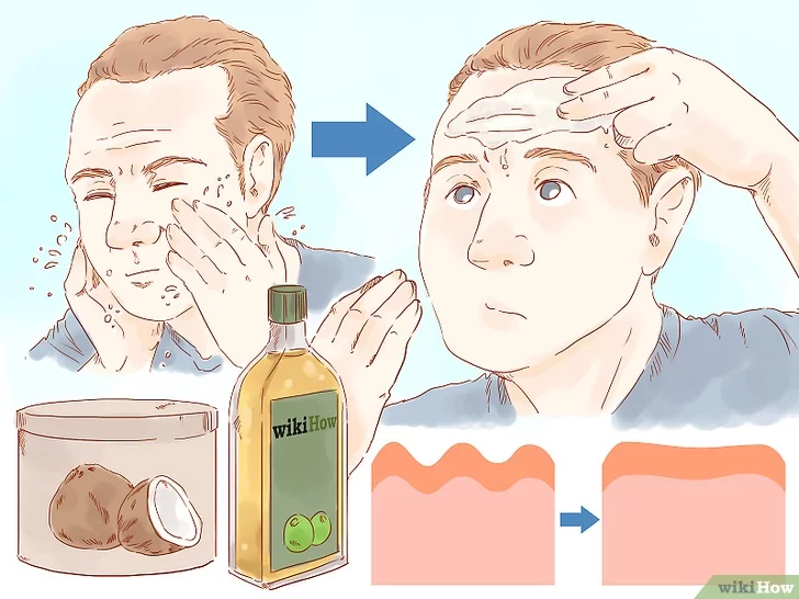 이마주름 없애기